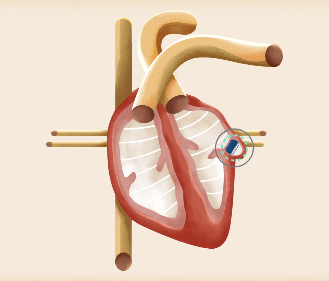 LAAR procedure image