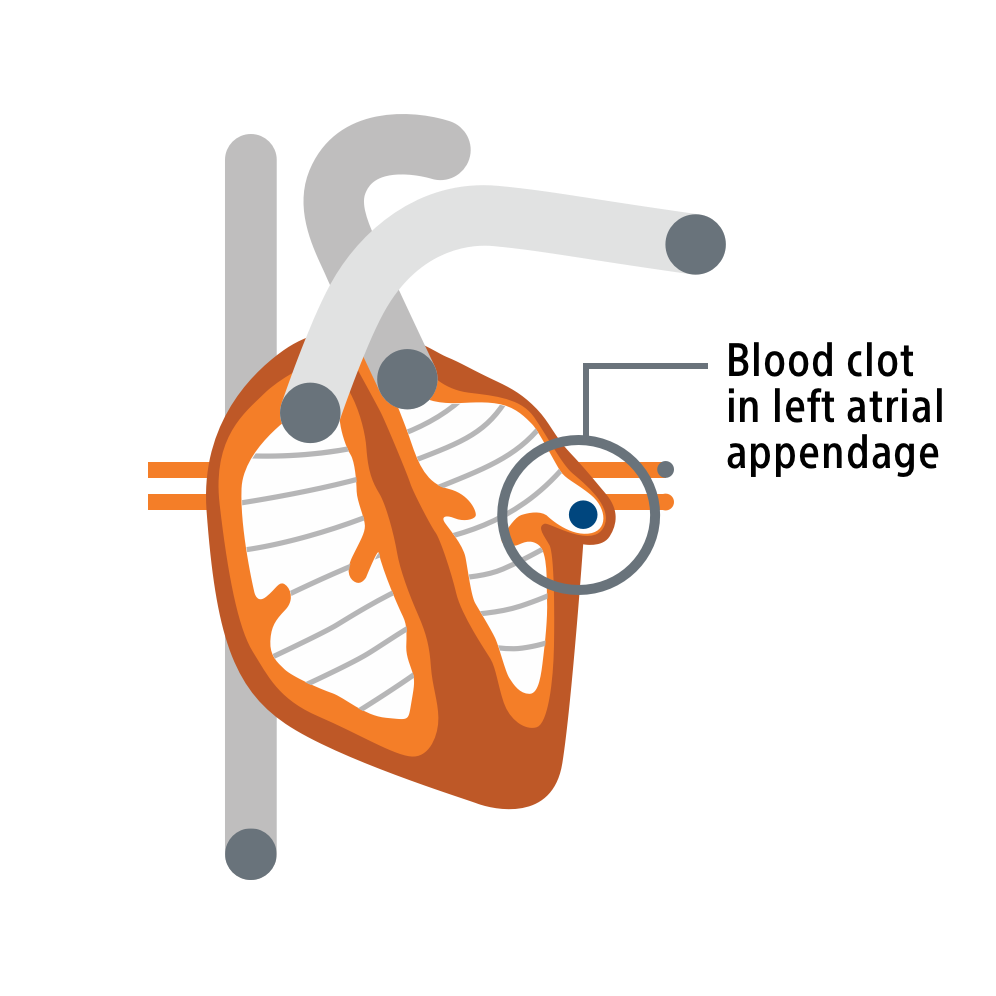 Heart illustration LAAC clot