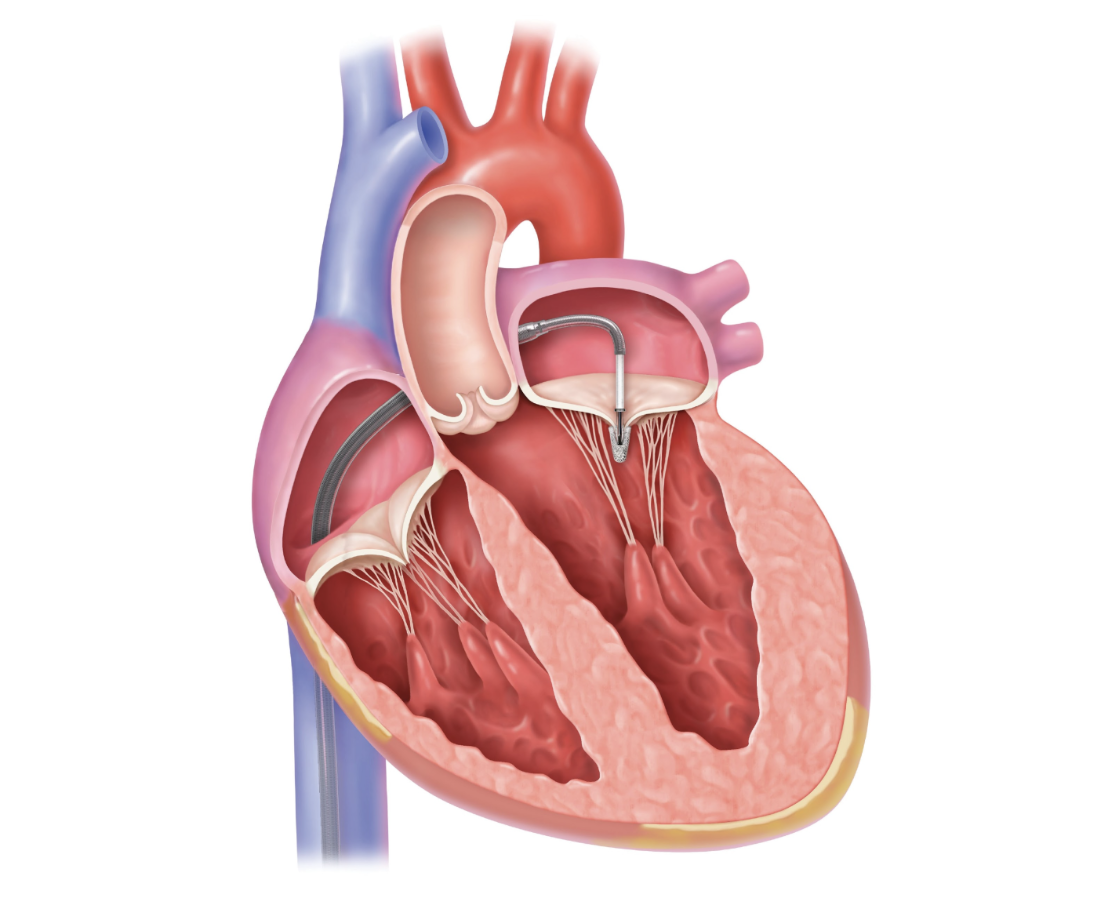 Post Procedure Heart